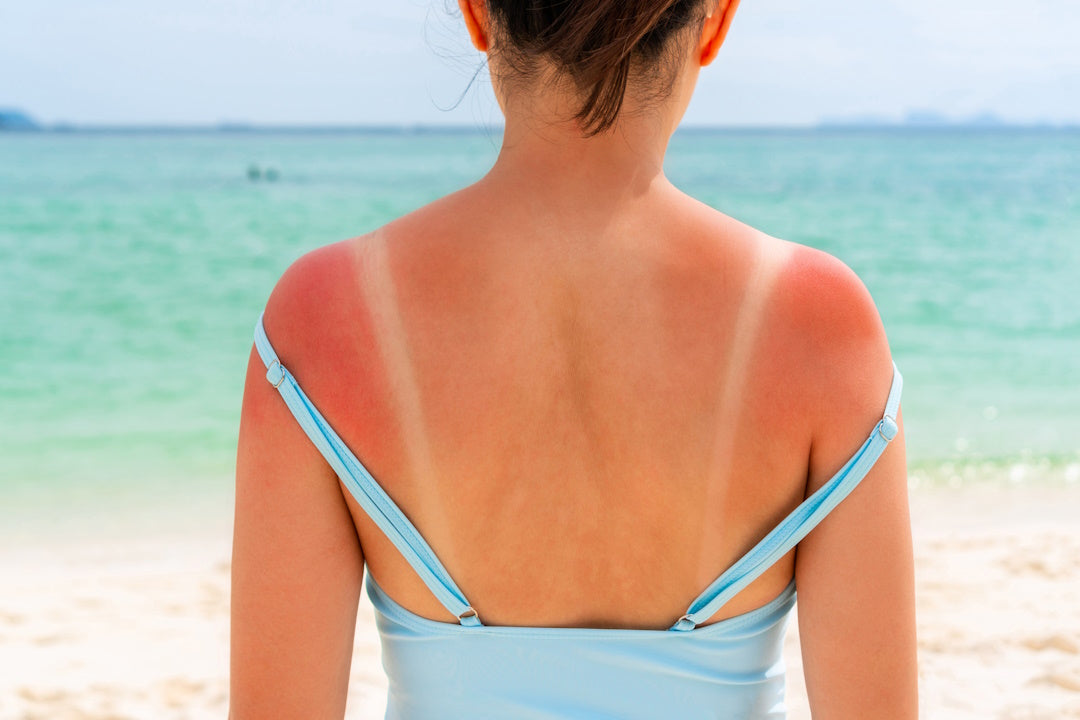 Rücken einer Frau mit Sonnenbrand am Strand
